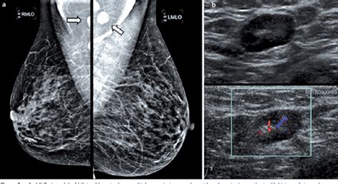 Figure 3 From Abnormal Axillary Lymph Nodes On Negative Mammograms