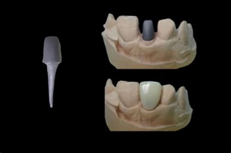 Dental Crown Post Crown On Implant What Is It
