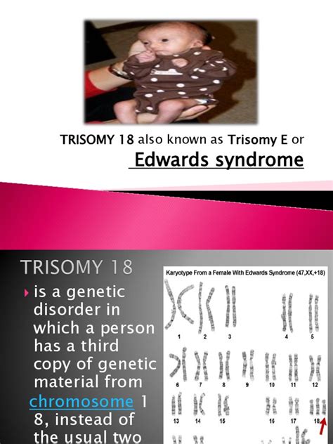 Trisomy 13 18 Diseases And Disorders Genetics