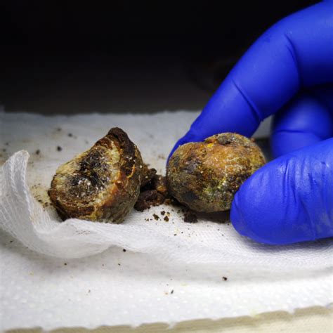 46 New Gene Variations Found To Increase Gallstone Risk The