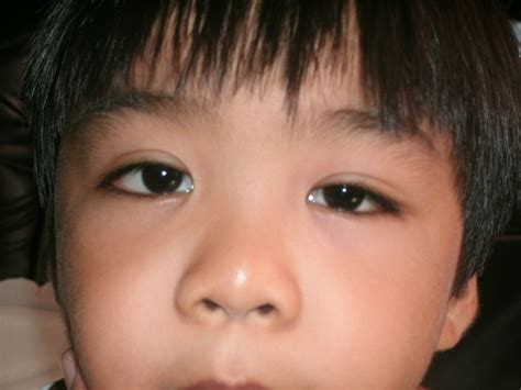 Sore Eyes Causes, Symptoms, Treatment and Prevention