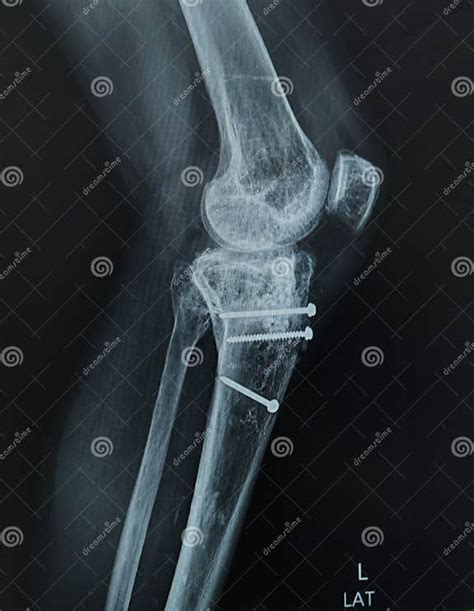 X Ray Left Knee Lateral View Avulsion Fracture Tibial Tubercle Post