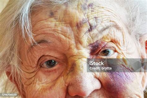 Closeup Of A 99 Year Old Woman With Bruises Stock Photo Download