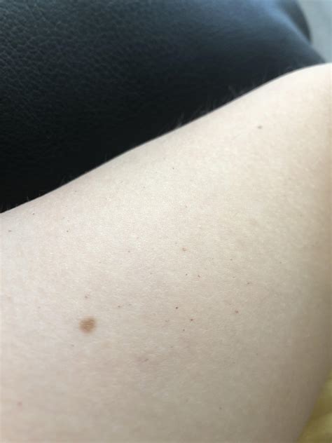 Any Idea What These Tiny Red Dots On My Arms Could Be A Little More