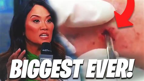 The Biggest Blackheads Ever Seen On Dr Pimple Popper Youtube