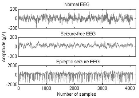 Epilepsy Seizure Eeg