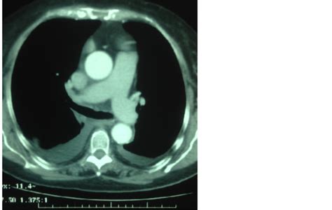 Mediastinal Metastasis 10 Years After Primary Renal Cell Carcinoma—a