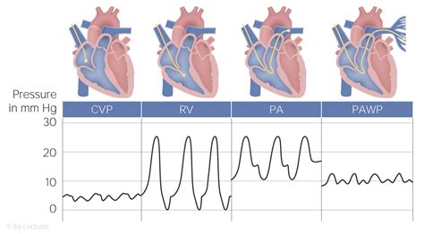 Pulmonary Artery Catheter Guide Cheat Sheet Lecturio