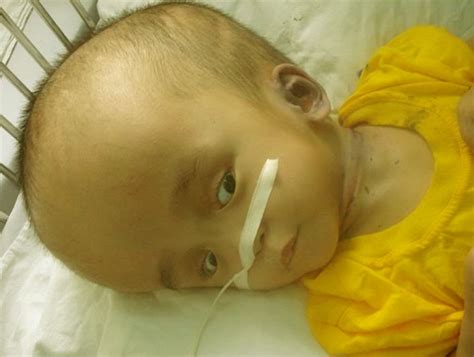 Hydrocephalus Pictures Symptoms Causes Treatment In Infants Adults