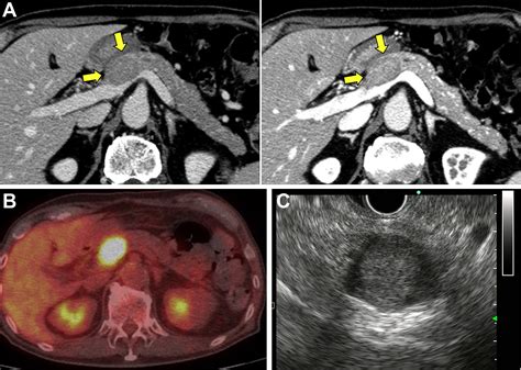 Pancreatic Mass In A Patient With An Increased Serum Level Of Igg4