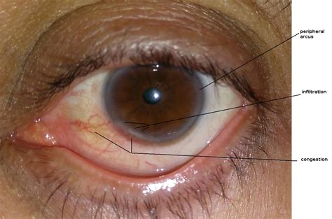 Eye Recurrent Inflammation At Edge Of Cornea Medical Sciences Stack