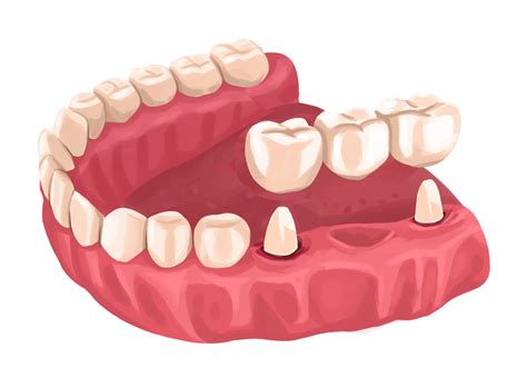 Dental Bridge - AFAM Dental