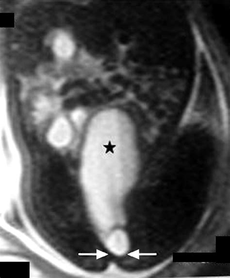 congenital imperforate hymen with hydrocolpos diagnosed using prenatal mri ajr