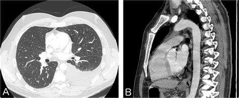 A Ct Scan Of The Chest Showing A Pleural Effusion B Ct Scan Of The