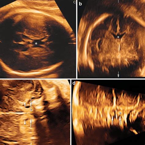Four Dimensional Us Of The Fetal Heart At 21 Weeks Of Gestation A B
