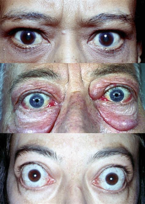 Graves' disease is an autoimmune disease that increases the activity of the thyroid, a small graves' disease is the most common cause of hyperthyroidism (overactive thyroid) in the world, accounting. Opinions on Graves' ophthalmopathy