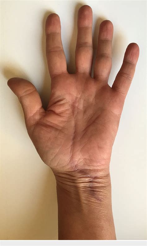 Figure 1 From Simultaneous Median And Ulnar Compression Neuropathy