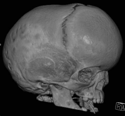 Craniosynostosispremature Closure Of Cranial Sutures Skull Shape
