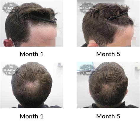 Hair Growth Success Story Excellent Results