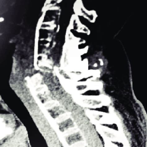 Ct Cervical Spine Sagittal View Showing Fracturedislocation Of C6