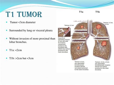 Ppt Lung Cancer Staging Powerpoint Presentation Free Download Id