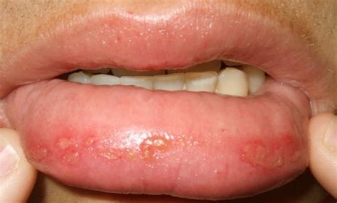 👉 Bumps On Lips Causes Treatment Pictures December 2021