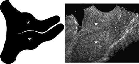 Ultrasound Evaluation Of The Gravid Cervix Obgyn Key