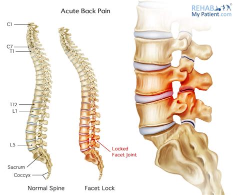 Acute Back Pain Rehab My Patient