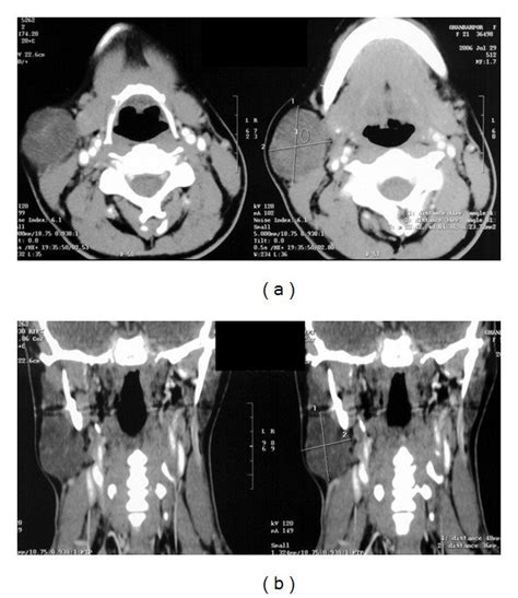 Contrast Enhanced CT Scan In Axial Views Of Neck A 36 48 Mm Soft