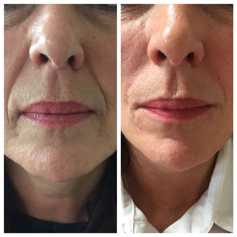 Dermal filler before and after #drhanna #filler | Dermal fillers, Lip fillers, Lipstick designs