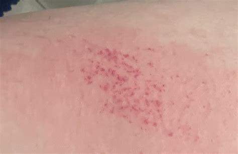 Rash Doesnt Really Itch No Bumps Different Areas Get It Once In A