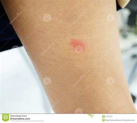 Allergic Rash At Woman Arm Stock Photo Image Of Integument 51751574