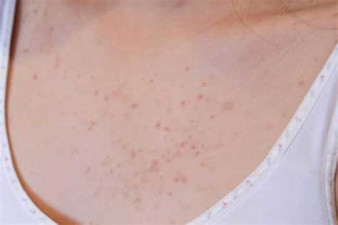 How Can I Get Rid Of Acne On My Chest Laptrinhx News