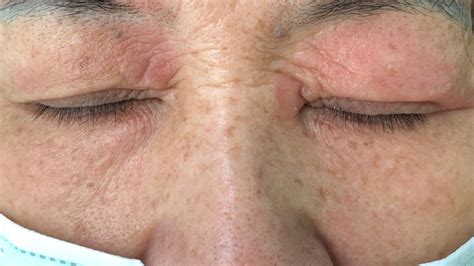 What Causes Rashes On Eyelids