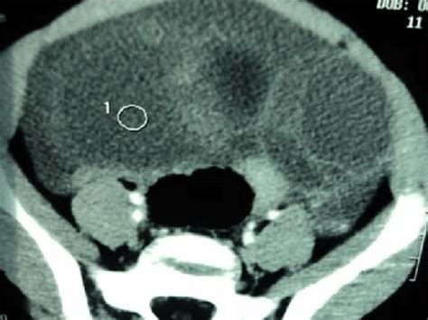 Pelvic And Abdominal Ct Scan Showed Bilateral Multiloculated Ovarian