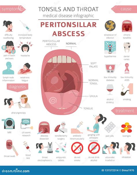 What Causes A Peritonsillar Abscess Peritonsillar Abscess For Teens