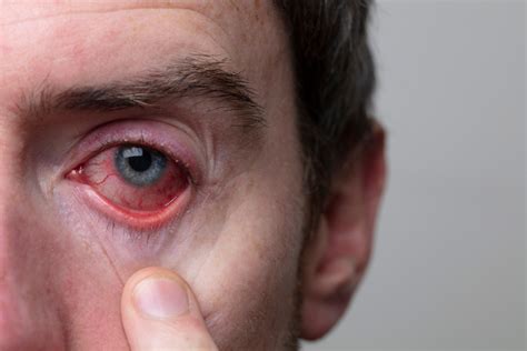Semnul din ochi care indică cele mai periculoase infecții cu
