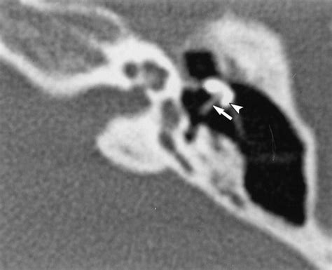 Ct Evaluation Of Prosthetic Ossicular Reconstruction Procedures What