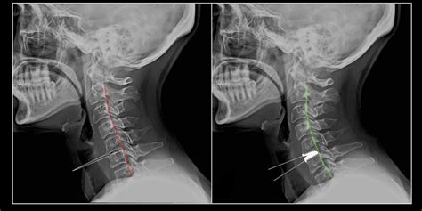 Straightened Cervical Lordosis What Does It Mean Symptoms Treatment