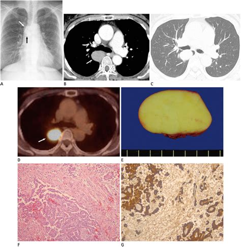 Immunotherapy And Malignant Pleural Mesothelioma