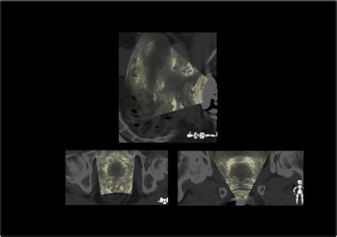 Development Of 3 Dimensional Transperineal Ultrasound For Image Guided