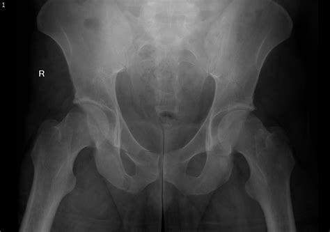 Pelvic Fracture X Ray