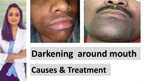 Skin Discoloration Around Mouth