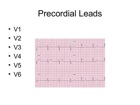 Ekg Lead Avr