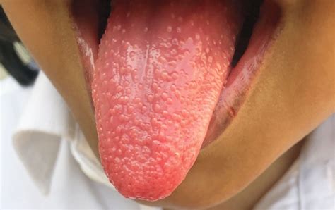 Strawberry Tongue In Streptococcal Pharyngitis Nejm