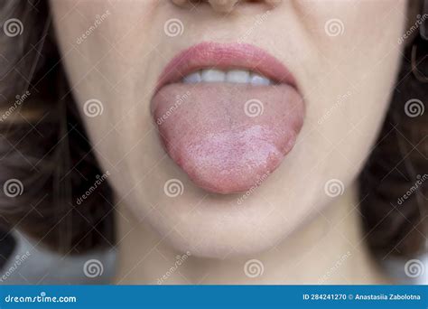 Close Up Swelling Of The Tongue Allergic Reactions Infections