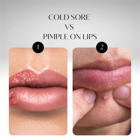 Cold Sore Vs Pimple On Lips 4 Absolute Differences And Treatment