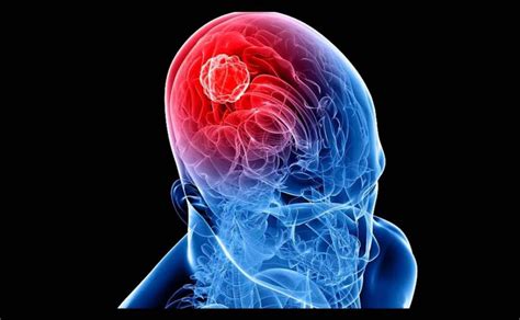 Al A O Diagnostican Mil Casos Nuevos De Tumores Cerebrales En El Mundo