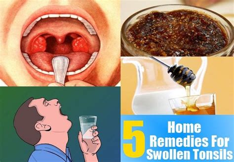 Remedies For Swollen Tonsils Sore Throat Pinterest Home Home