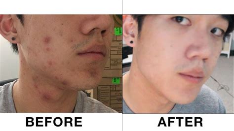 Banish Acne Scars Does It Really Work Plus My New Apartment Youtube